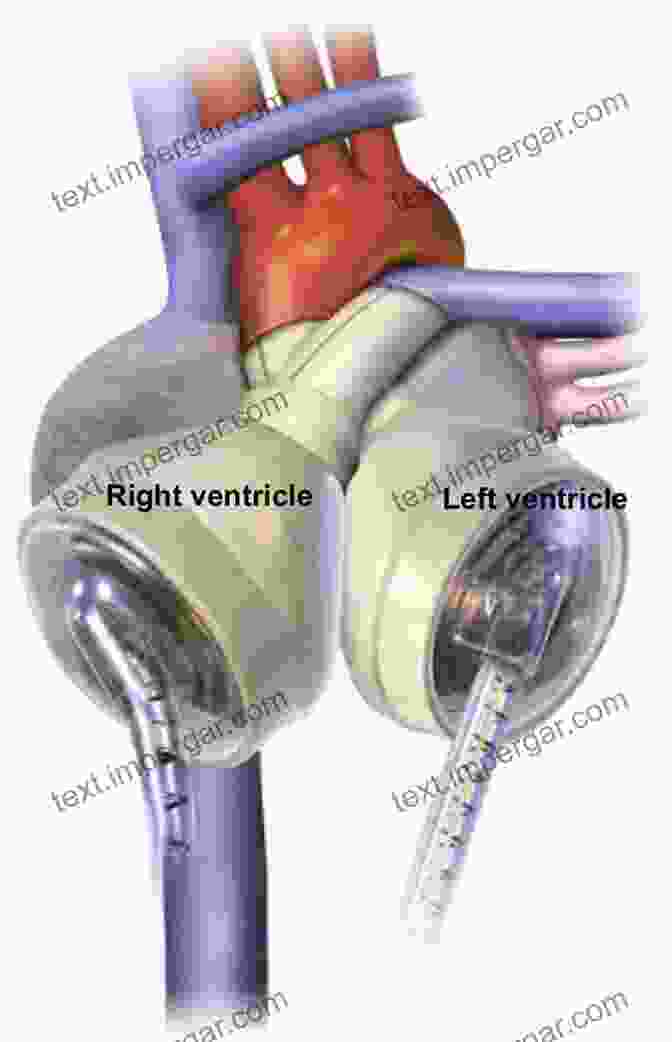 Artificial Heart Surgery Artificial Hearts: Technology And Therapy Management