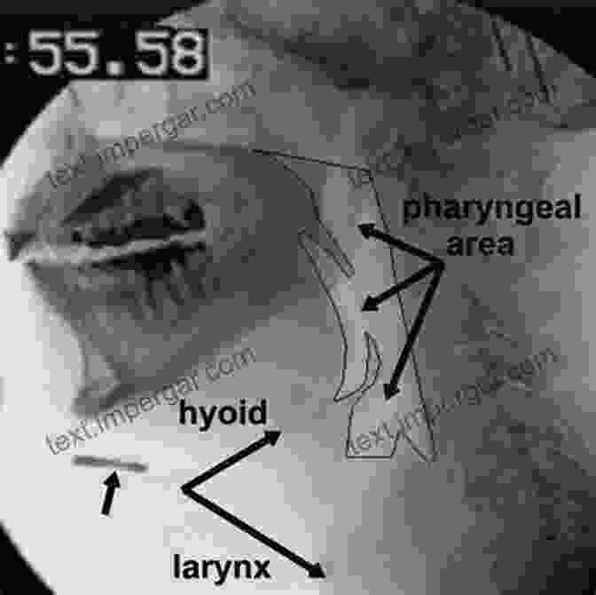 Fluoroscopic Image Of Dysphagia The Clinician S Guide To Swallowing Fluoroscopy