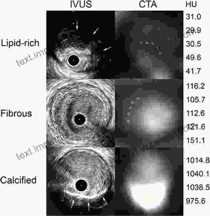 Ultrasound Images Demonstrating Different Plaque Morphologies: Echolucent, Echogenic, Calcified, And Irregular. Ultrasound And Carotid Bifurcation Atherosclerosis