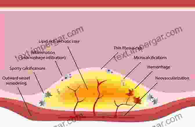 Ultrasound Images Showing A Stable Plaque With A Thick Fibrous Cap (left) And A Vulnerable Plaque With A Thin Fibrous Cap And Neovascularization (right). Ultrasound And Carotid Bifurcation Atherosclerosis