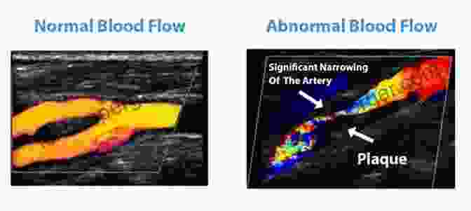 Ultrasound Images Showing Color Doppler Images Of Normal Blood Flow (left) And Disturbed Flow (right) In The Carotid Bifurcation. Ultrasound And Carotid Bifurcation Atherosclerosis