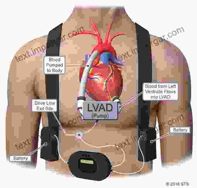 Ventricular Assist Device Implant Artificial Hearts: Technology And Therapy Management