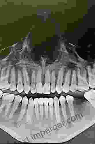 Impacted Third Molars