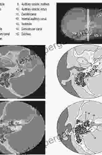 Temporal Bone Imaging (Medical Radiology)