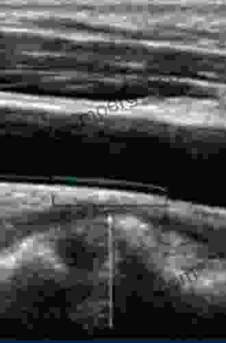 Ultrasound And Carotid Bifurcation Atherosclerosis